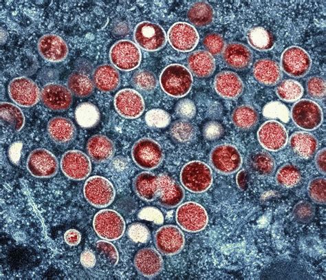 cebu sex scandal|No mpox cases in Cebu City – DOH.